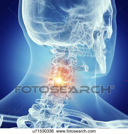 Illustration of a painful cervical spine View Large Photo Image Stock Photograph - Illustration of a painful cervical spine. Fotosearch
