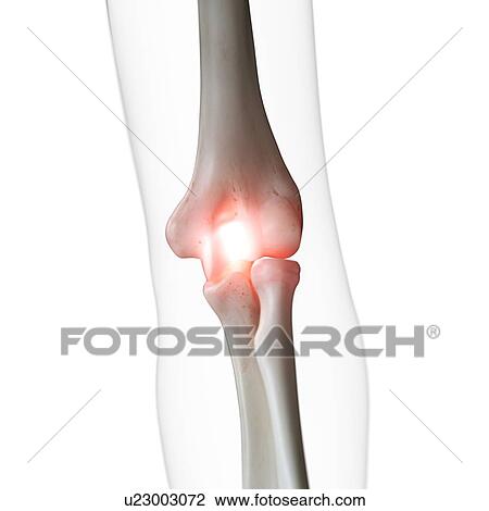 Stock Image - Illustration of a painful elbow joint. Fotosearch