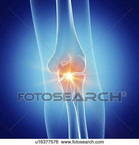 Stock Photograph - Illustration of a painful elbow joint. Fotosearch