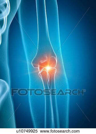 Illustration of a painful elbow joint View Large Photo Image Stock Photography - Illustration of a painful elbow joint. Fotosearch