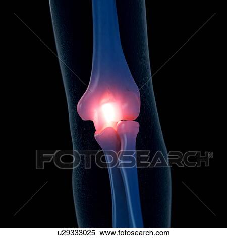 Stock Photography - Illustration of a painful elbow. Fotosearch