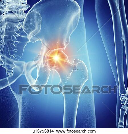 Picture - Illustration of a painful hip joint. Fotosearch