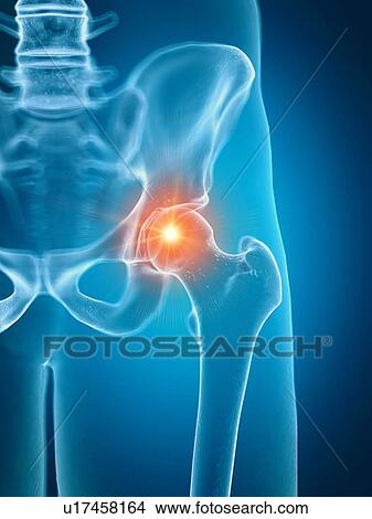 Picture - Illustration of a painful hip joint. Fotosearch