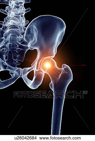 Illustration of a painful hip joint View Large Photo Image Picture - Illustration of a painful hip joint. Fotosearch