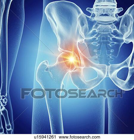 Illustration of a painful hip joint View Large Photo Image Stock Image - Illustration of a painful hip joint. Fotosearch