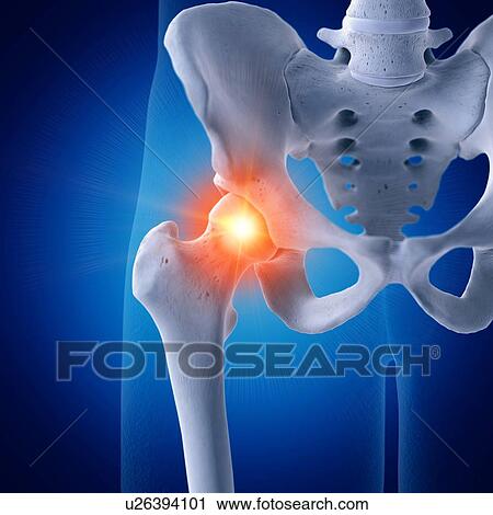 Stock Image - Illustration of a painful hip joint. Fotosearch