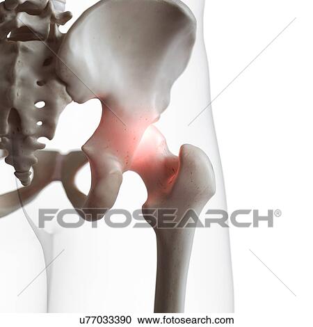 Stock Image - Illustration of a painful hip joint. Fotosearch