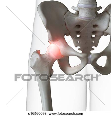 Illustration of a painful hip joint View Large Photo Image Stock Photo - Illustration of a painful hip joint. Fotosearch