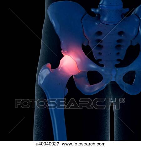 Stock Photo - Illustration of a painful hip joint. Fotosearch