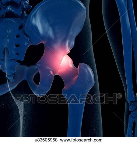 Illustration of a painful hip joint View Large Photo Image Stock Photo - Illustration of a painful hip joint. Fotosearch