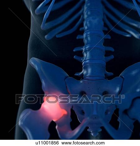 Illustration of a painful hip joint View Large Photo Image Stock Photograph - Illustration of a painful hip joint. Fotosearch