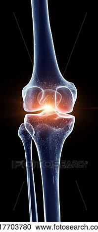 Illustration of a painful knee joint View Large Photo Image Stock Image - Illustration of a painful knee joint. Fotosearch