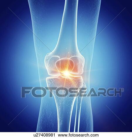 Stock Image - Illustration of a painful knee. Fotosearch
