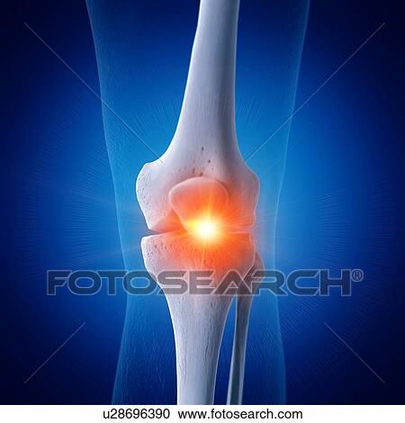 Illustration of a painful knee View Large Photo Image Stock Image - Illustration of a painful knee. Fotosearch