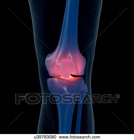 Stock Image - Illustration of a painful knee. Fotosearch