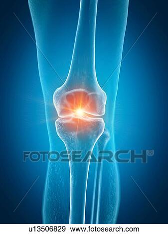 Stock Photo - Illustration of a painful knee. Fotosearch