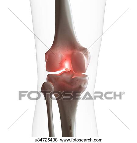 Illustration of a painful knee View Large Photo Image Stock Photo - Illustration of a painful knee. Fotosearch