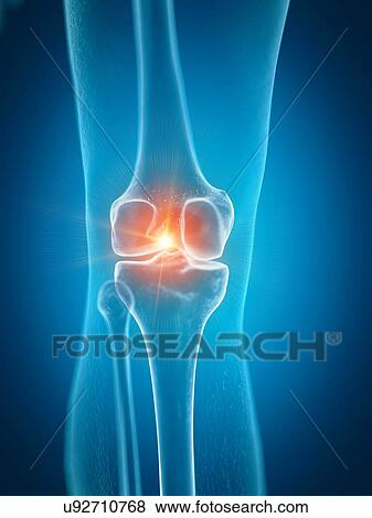 Stock Photo - Illustration of a painful knee. Fotosearch