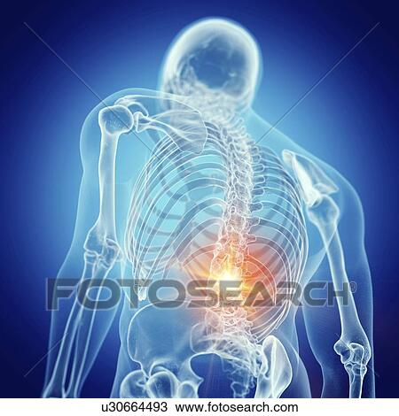 Illustration of a painful lower back View Large Photo Image Stock Image - Illustration of a painful lower back. Fotosearch