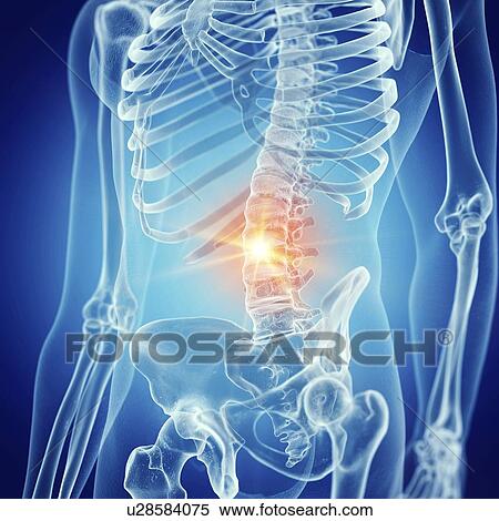 Stock Photography - Illustration of a painful lower back. Fotosearch