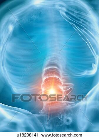 Illustration of a painful lower spine View Large Photo Image Stock Image - Illustration of a painful lower spine. Fotosearch
