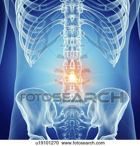 Stock Image - Illustration of a painful lumbar spine. Fotosearch