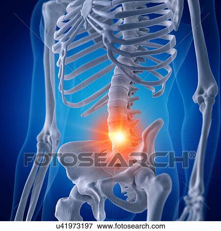 Stock Photo - Illustration of a painful lumbar spine. Fotosearch
