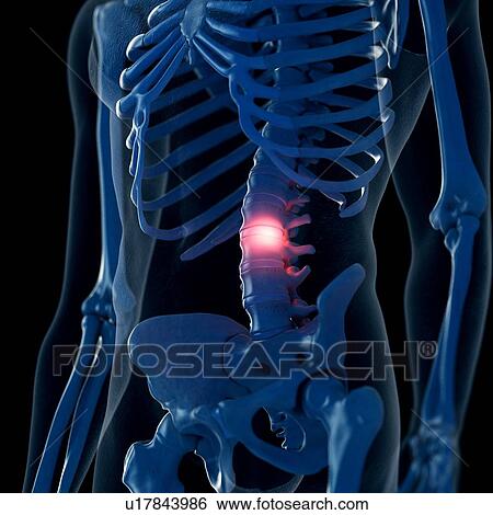 Illustration of a painful lumbar spine View Large Photo Image Stock Photograph - Illustration of a painful lumbar spine. Fotosearch