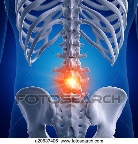 Stock Photograph - Illustration of a painful lumbar spine. Fotosearch