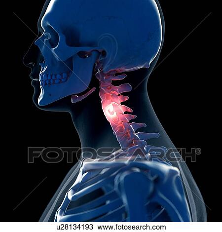 Illustration of a painful neck View Large Photo Image Stock Image - Illustration of a painful neck. Fotosearch