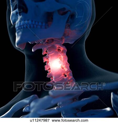 Illustration of a painful neck View Large Photo Image Stock Photo - Illustration of a painful neck. Fotosearch