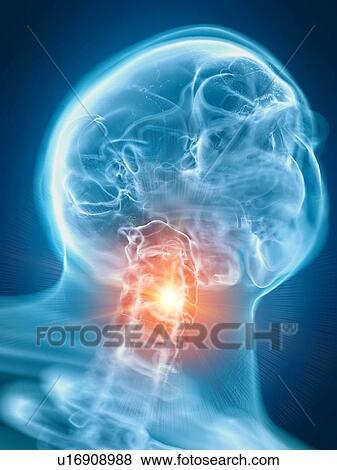 Stock Photo - Illustration of a painful neck. Fotosearch