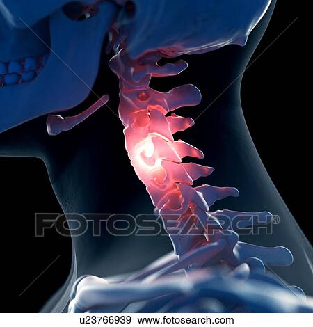 Illustration of a painful neck View Large Photo Image Stock Photo - Illustration of a painful neck. Fotosearch