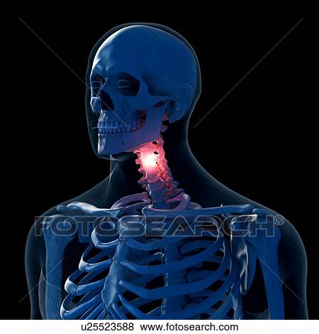 Illustration of a painful neck View Large Photo Image Stock Photo - Illustration of a painful neck. Fotosearch