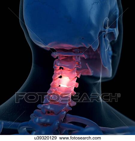 Illustration of a painful neck View Large Photo Image Stock Photo - Illustration of a painful neck. Fotosearch