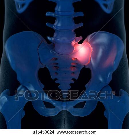 Picture - Illustration of a painful sacrum joint. Fotosearch