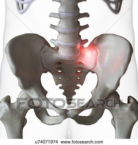 Picture - Illustration of a painful sacrum joint. Fotosearch