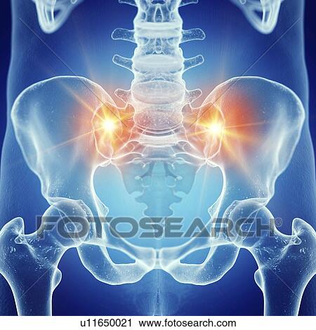 Stock Image - Illustration of a painful sacrum joint. Fotosearch