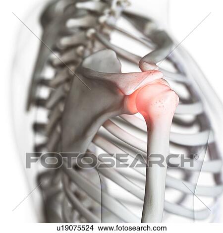 Illustration of a painful shoulder joint View Large Photo Image Picture - Illustration of a painful shoulder joint. Fotosearch