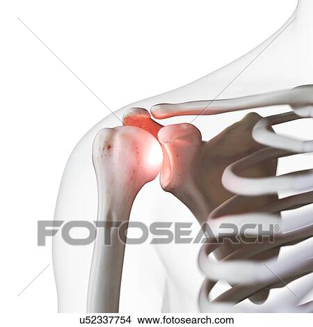 Picture - Illustration of a painful shoulder joint. Fotosearch