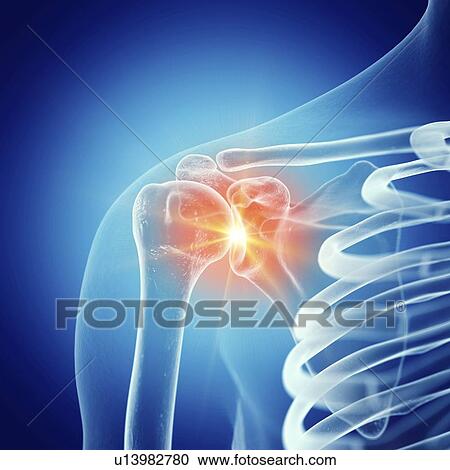 Illustration of a painful shoulder joint View Large Photo Image Stock Image - Illustration of a painful shoulder joint. Fotosearch