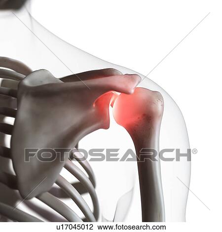 Stock Image - Illustration of a painful shoulder joint. Fotosearch