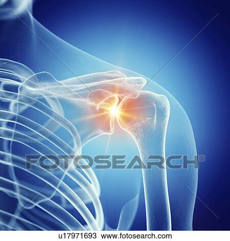 Stock Image - Illustration of a painful shoulder joint. Fotosearch