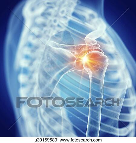 Illustration of a painful shoulder joint View Large Photo Image Stock Photo - Illustration of a painful shoulder joint. Fotosearch