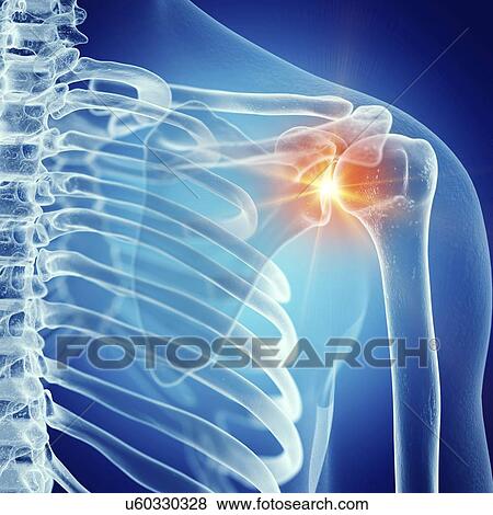 Stock Photo - Illustration of a painful shoulder joint. Fotosearch