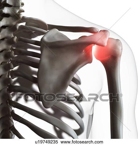 Illustration of a painful shoulder joint View Large Photo Image Stock Photography - Illustration of a painful shoulder joint. Fotosearch