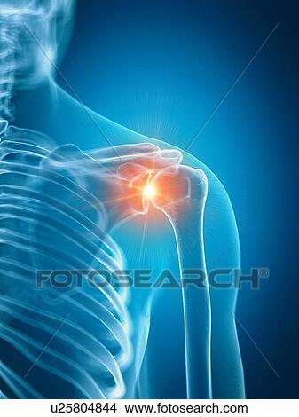 Picture - Illustration of a painful shoulder. Fotosearch