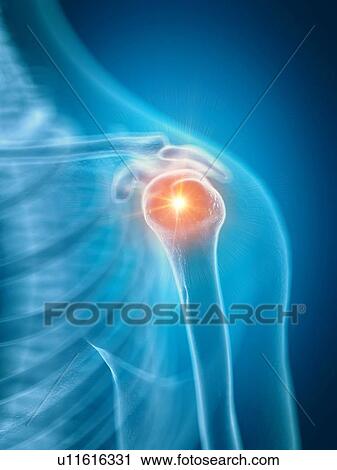 Stock Image - Illustration of a painful shoulder. Fotosearch