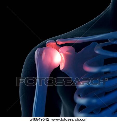 Stock Image - Illustration of a painful shoulder. Fotosearch
