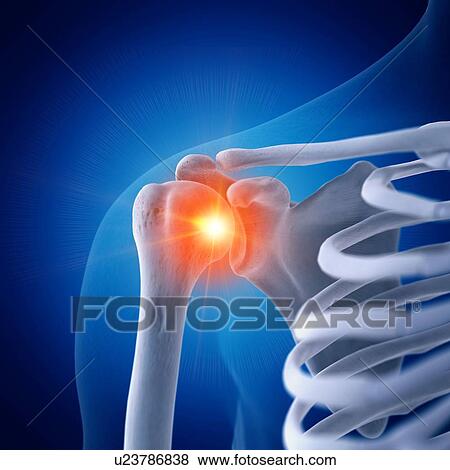Stock Photo - Illustration of a painful shoulder. Fotosearch